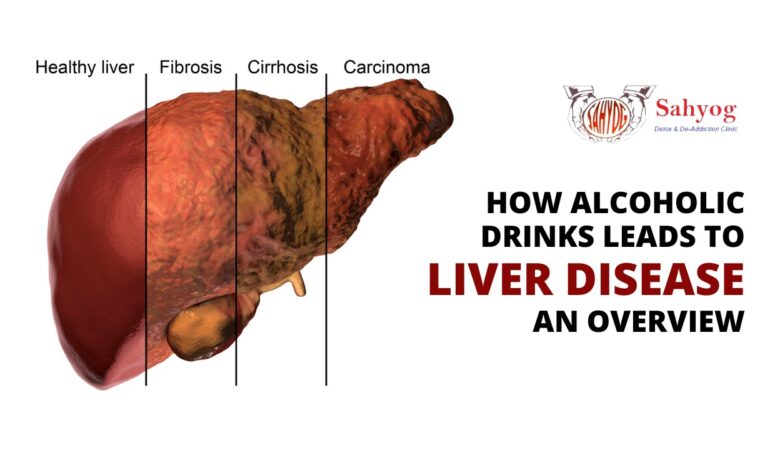 How Alcoholic Drinks Leads to Liver Disease: An Overview