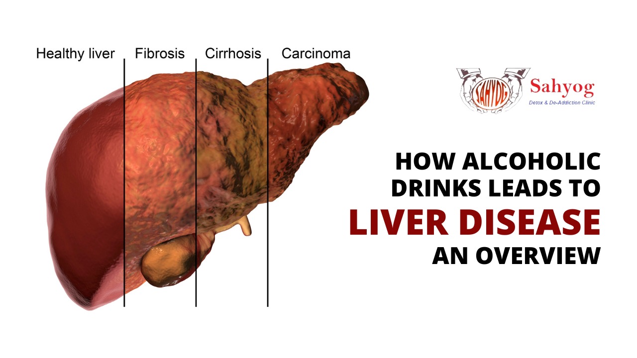 How Alcoholic Drinks Leads to Liver Disease An Overview